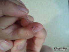 如果我的左拇指莫名地肿怎么办？