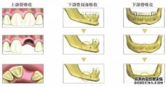 出色的牙槽骨生长，严重的牙槽骨吸收